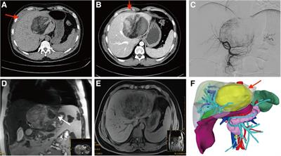 Transcatheter arterial embolization followed by laparoscopic anatomic hepatectomy for spontaneous rupture of a giant hepatic angiomyolipoma: a case report
